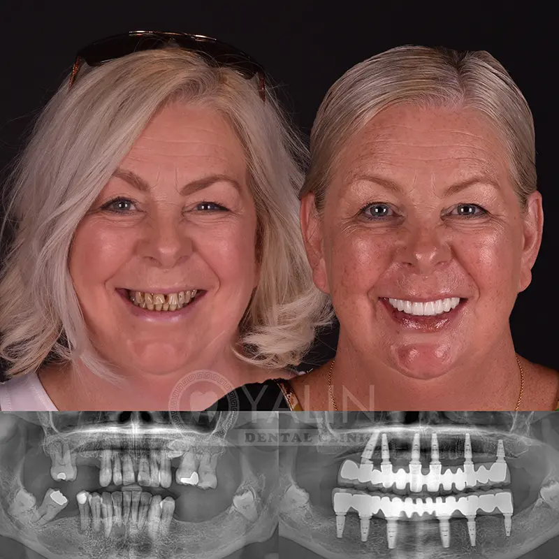 all-on-4, all-on-6-treatments, Yalindental Clinic