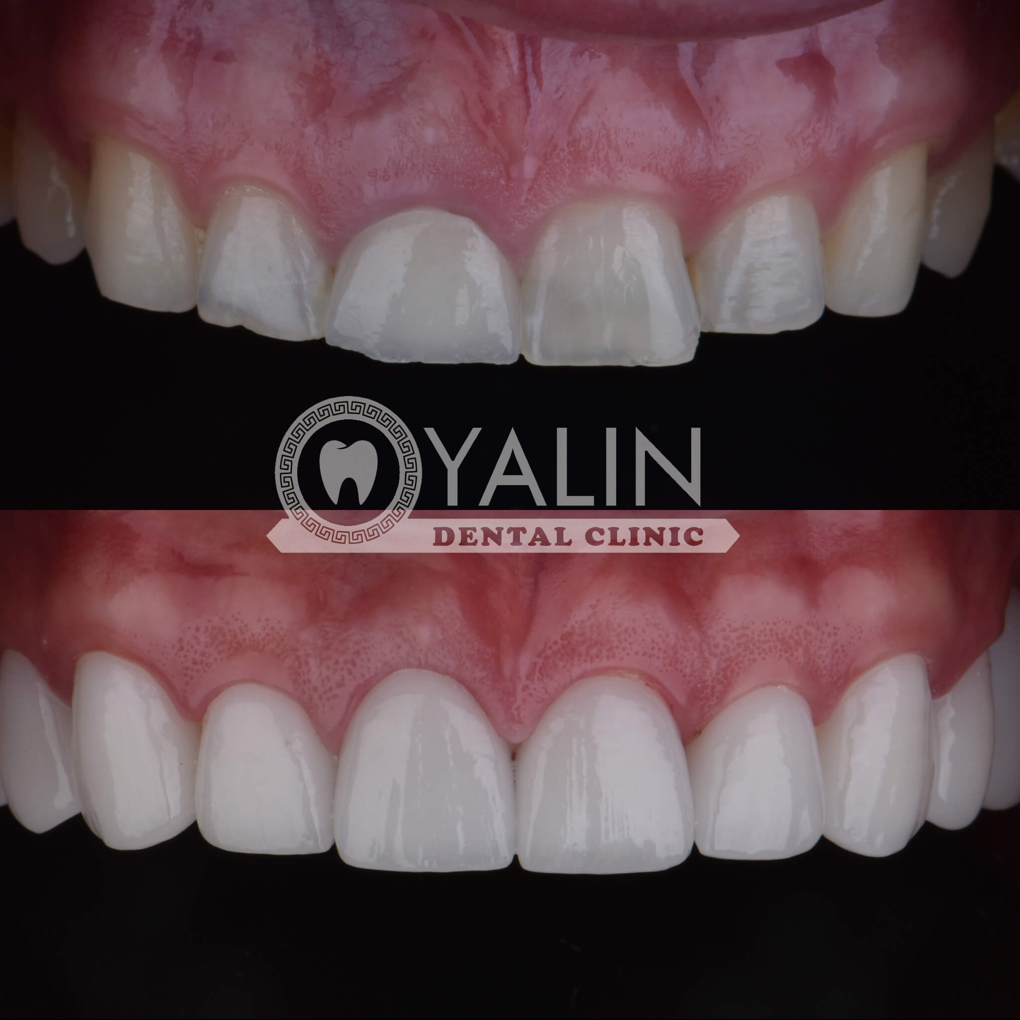 Ya Kont - Dental Clinic Antalya – FR - Yalın Dental Clinic