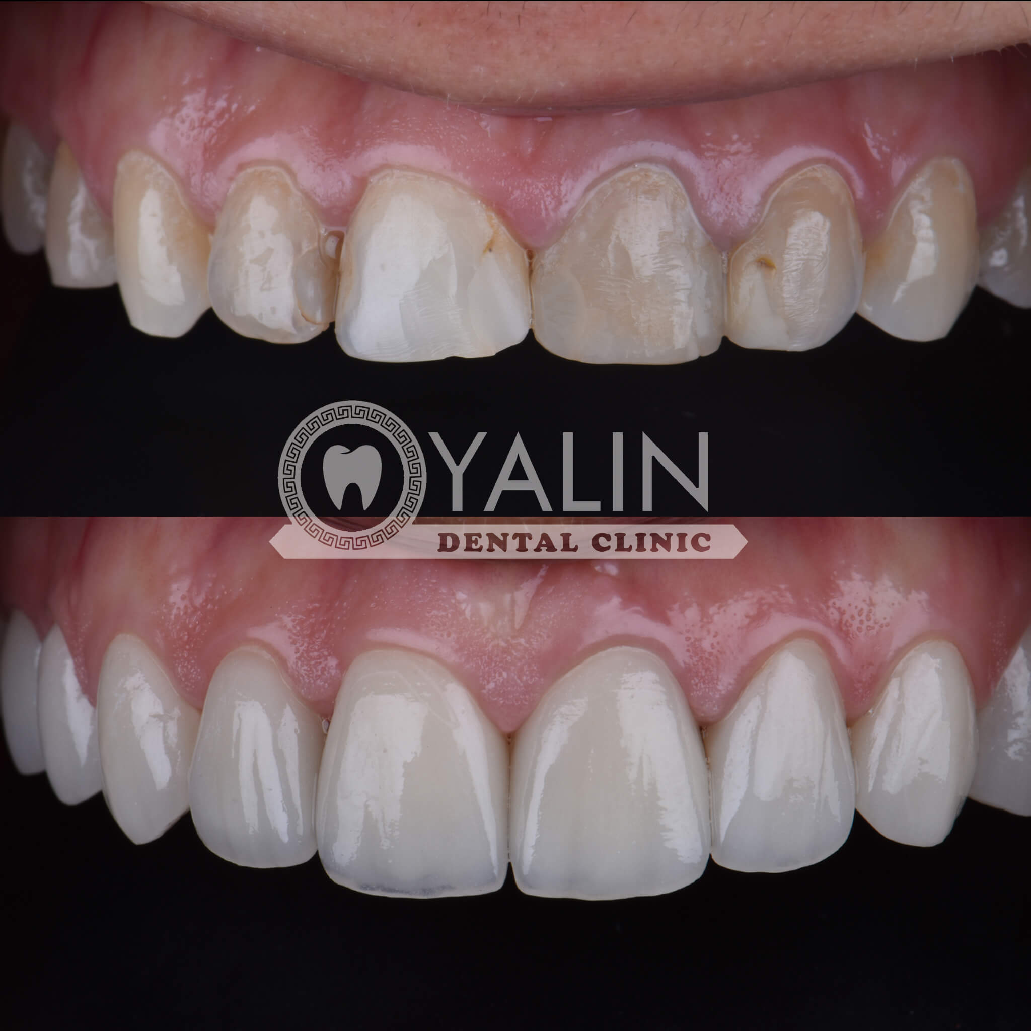 Ya Kont - Dental Clinic Antalya – FR - Yalın Dental Clinic