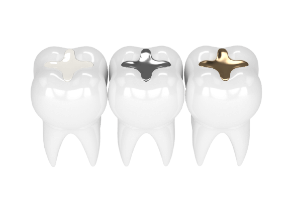 Antalya Dental Filling Prices Removebg Preview - WHITE DENTAL FILLING - Yalın Dental Clinic