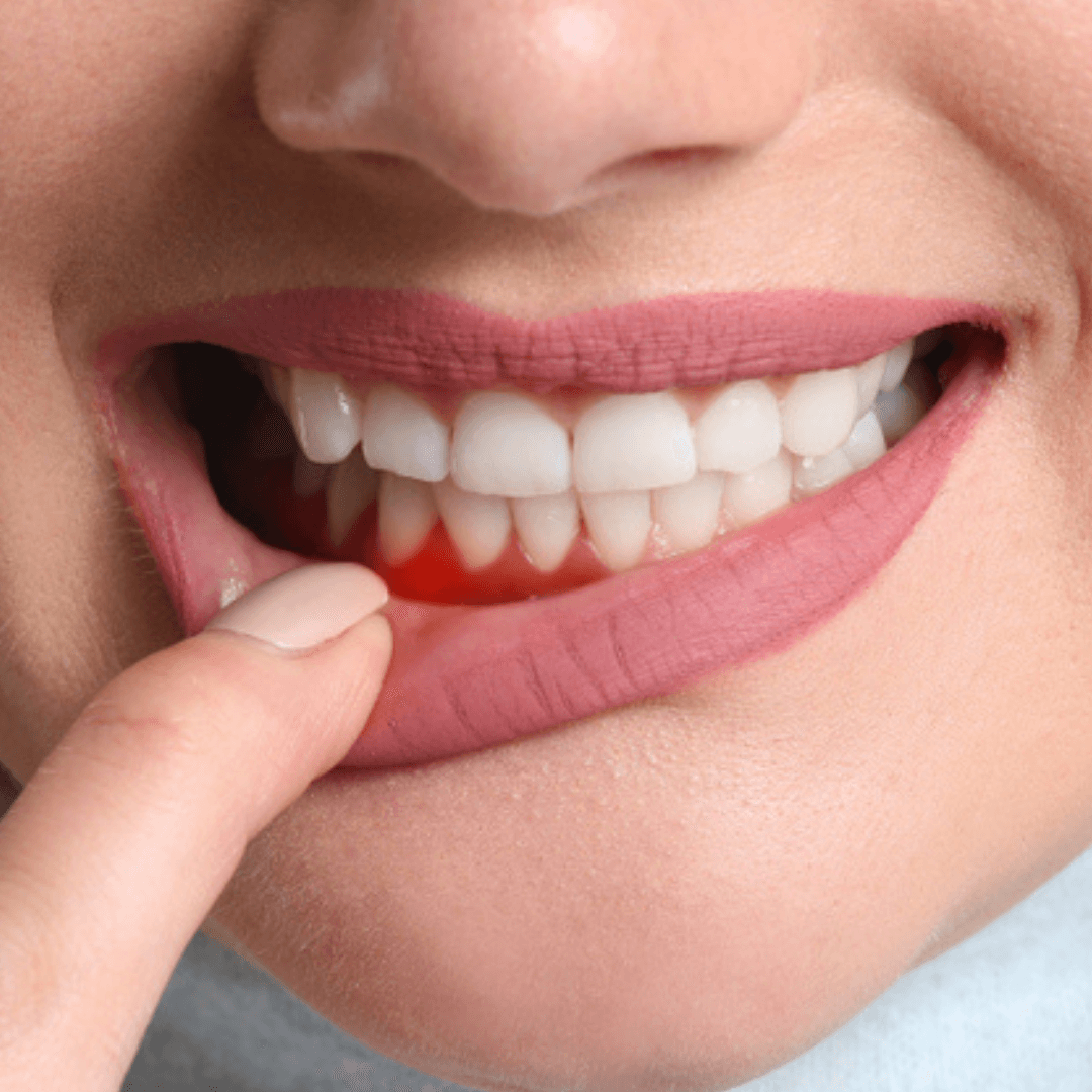 Gum Contoiring - GUM CONTOURING - Yalın Dental Clinic