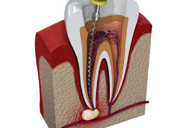 Turkey Antalya Dental Canal Treatment Removebg Preview - ROOT CANAL TREATMENTS - Yalın Dental Clinic