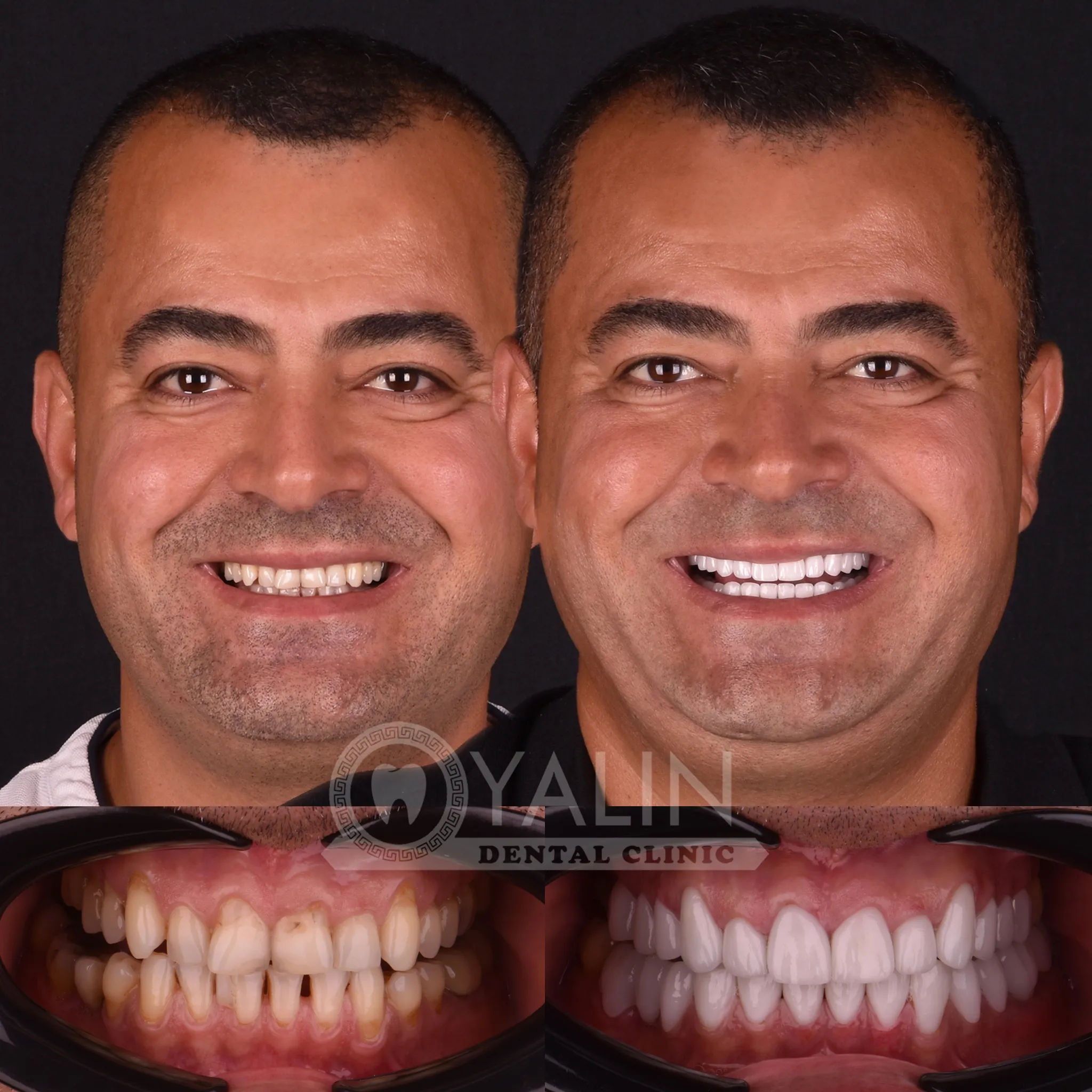 CHARBEL 2 Get teeth done in Turkey Antalya 2