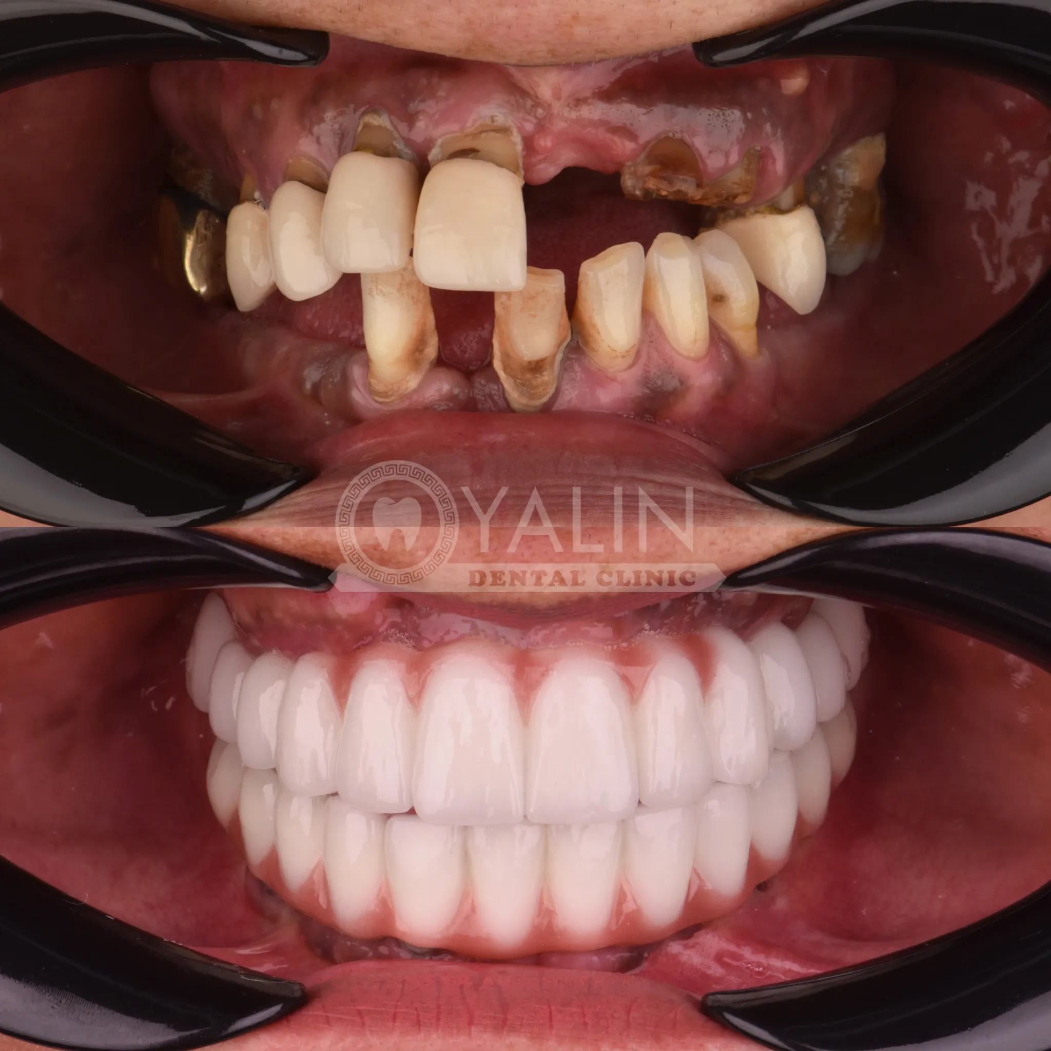 Dental Implant in Antalya Turkey 2
