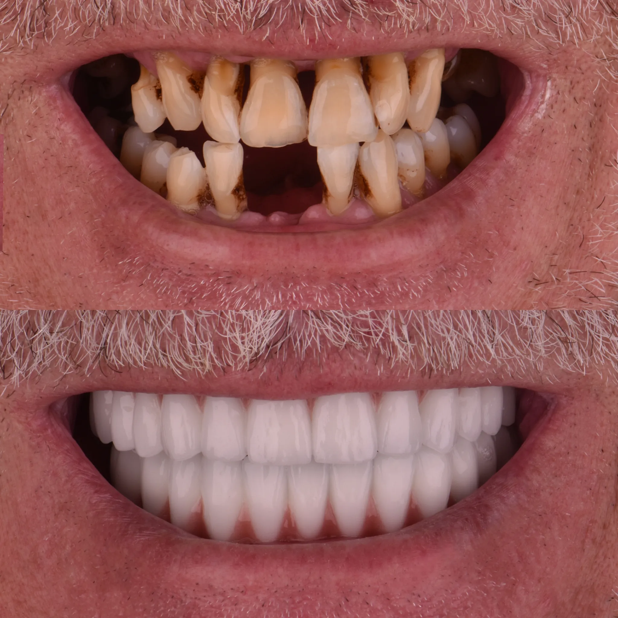Dental Implant in Antalya Turkey 4