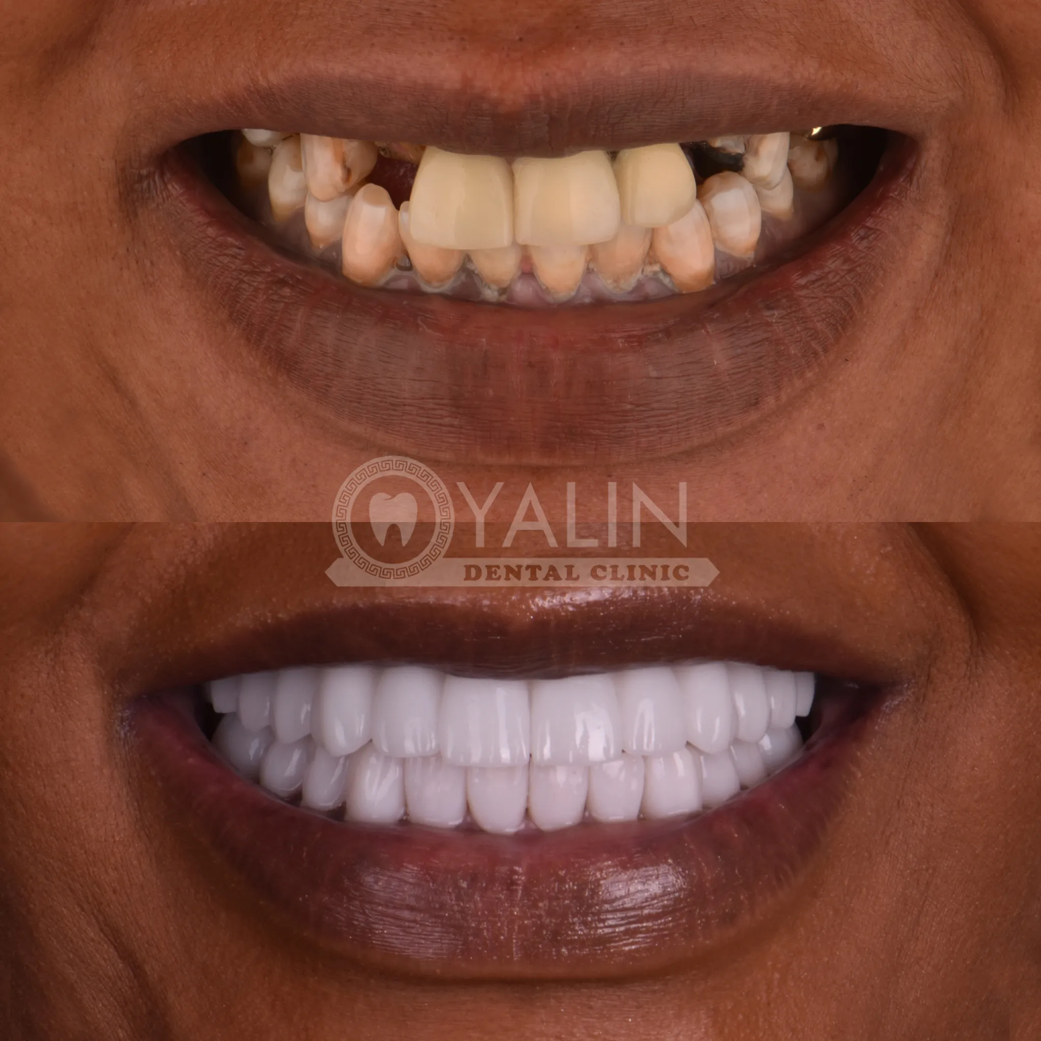 Dental implant in Antalya Turkey 1 2
