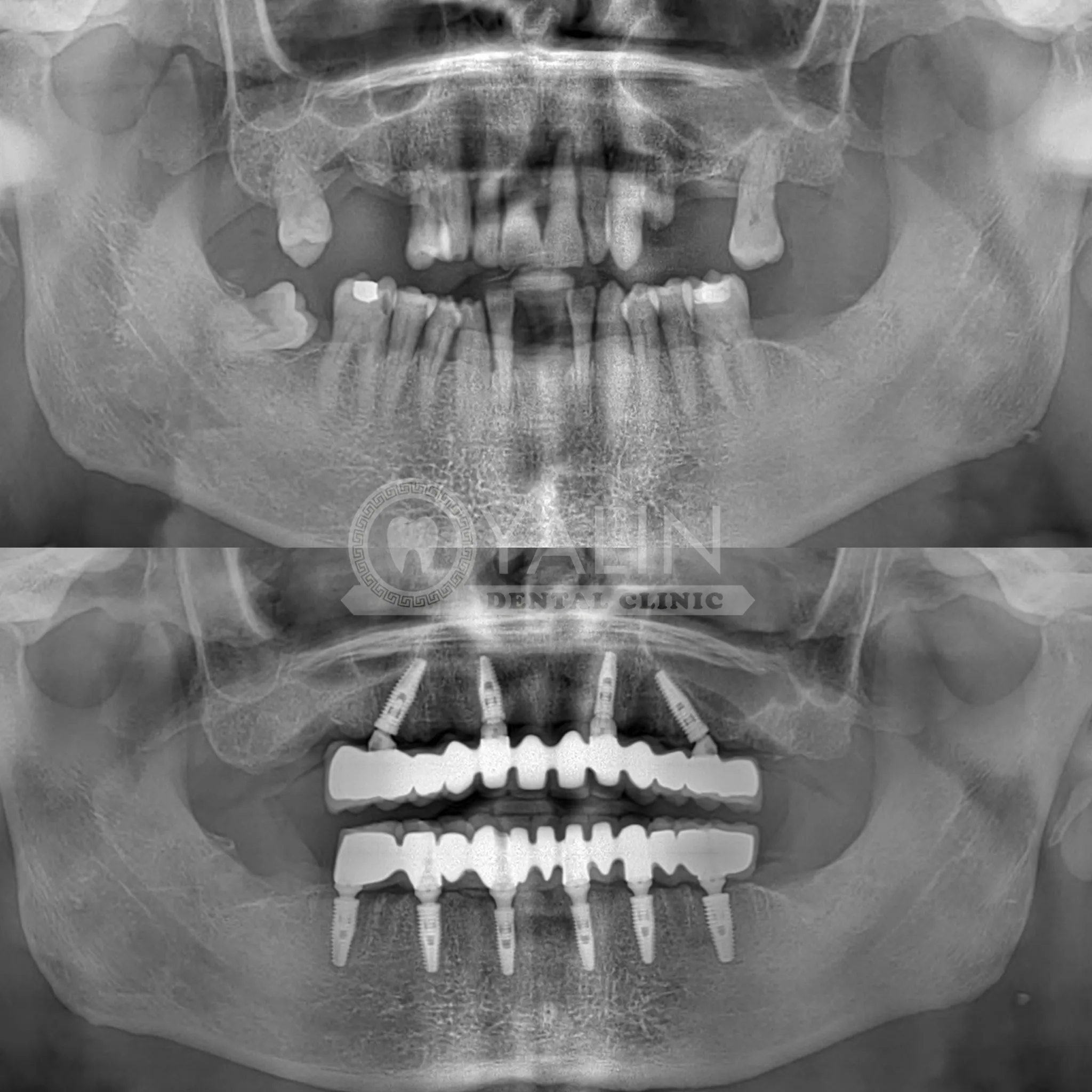 Dental implant in Antalya Turkey 3 1