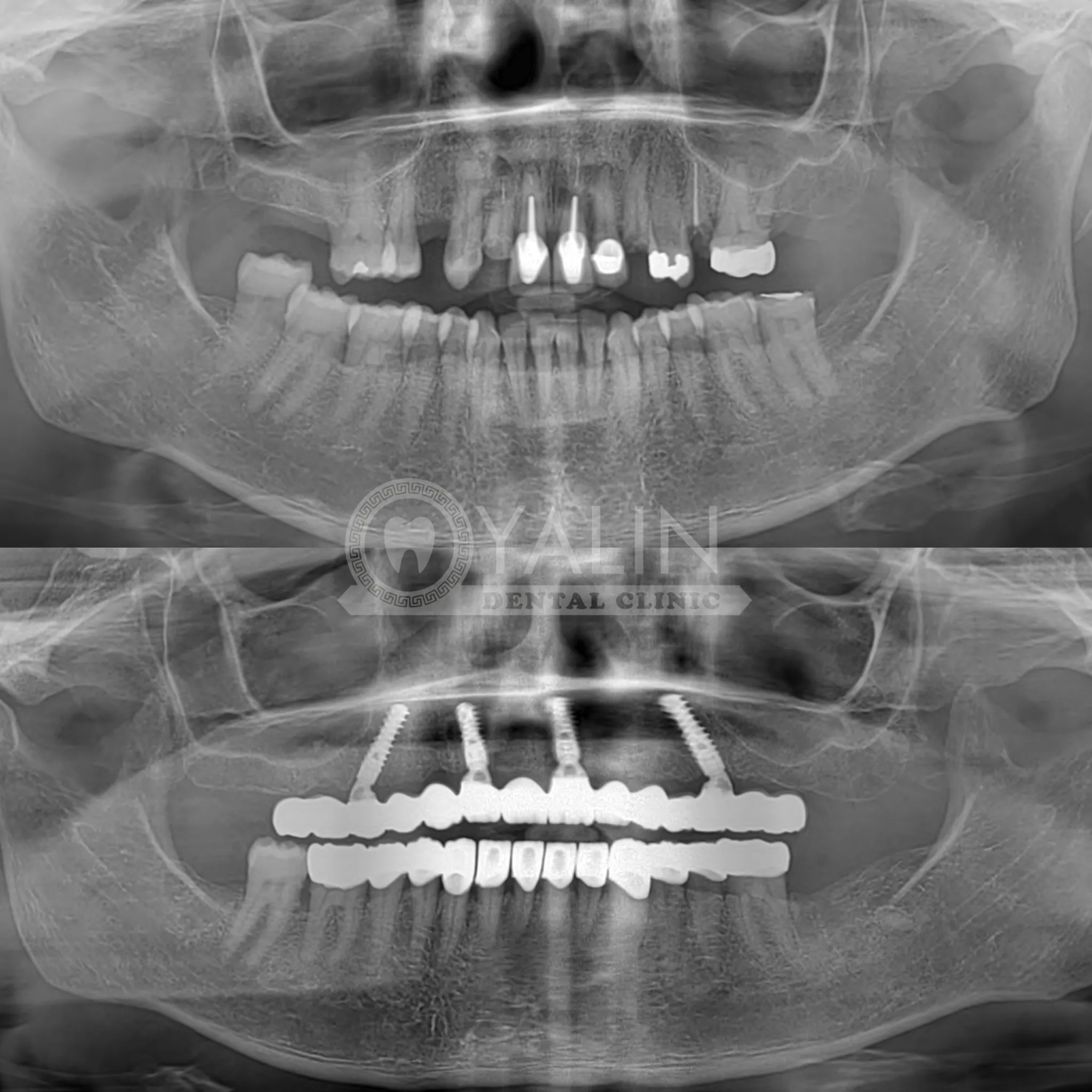 Dental implant in Antalya Turkey 3 2
