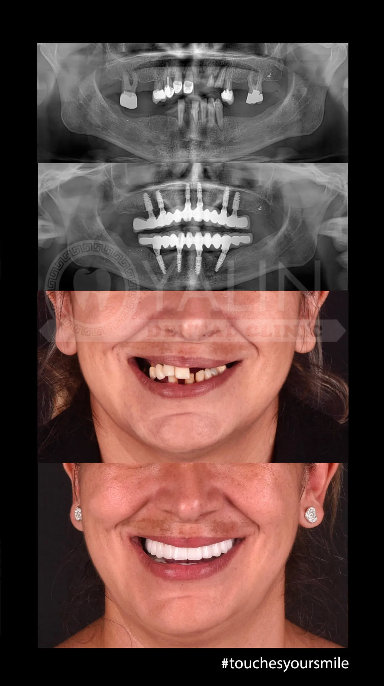 Dental implant in Antalya Turkey 4 1