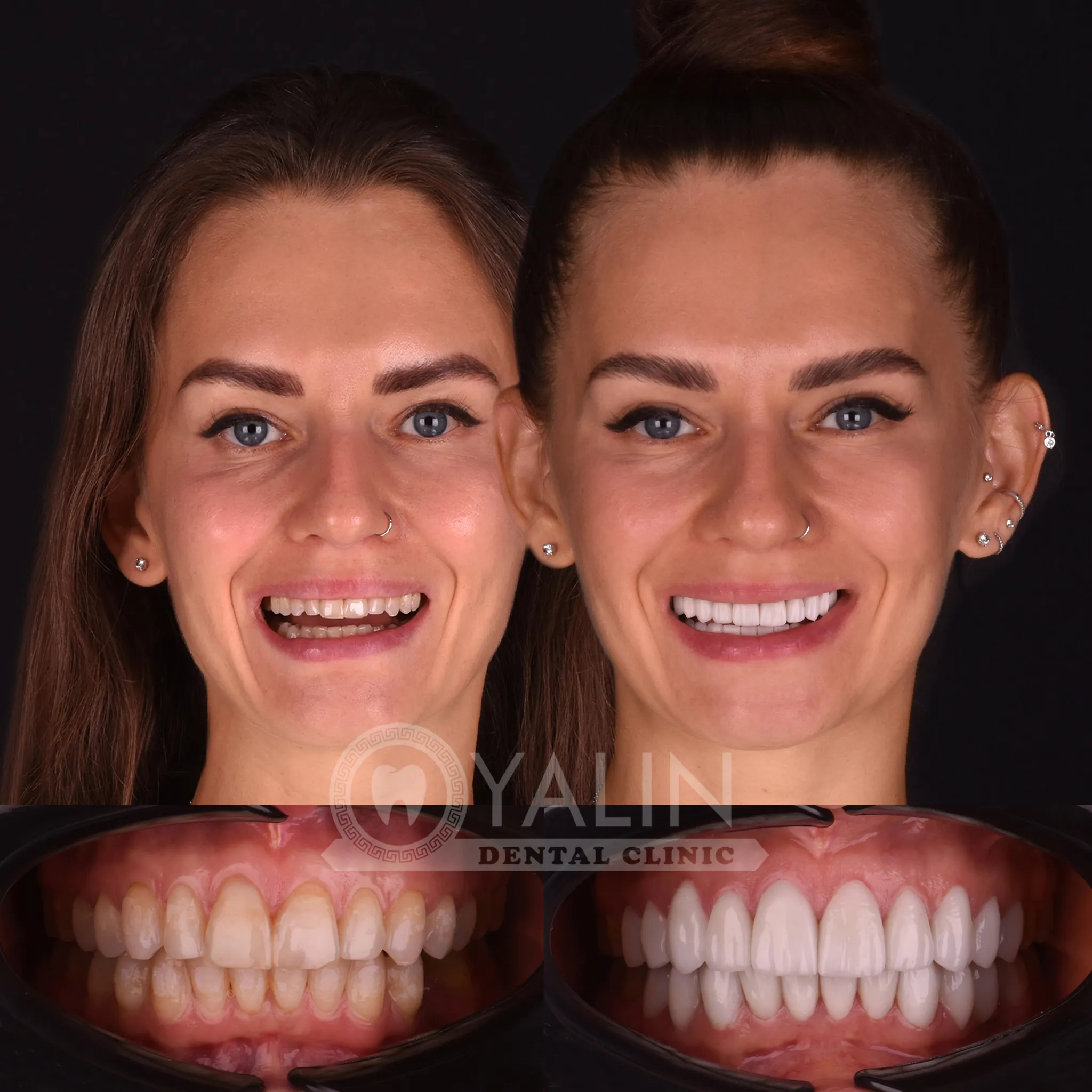 Turkey teeth veneers price 2
