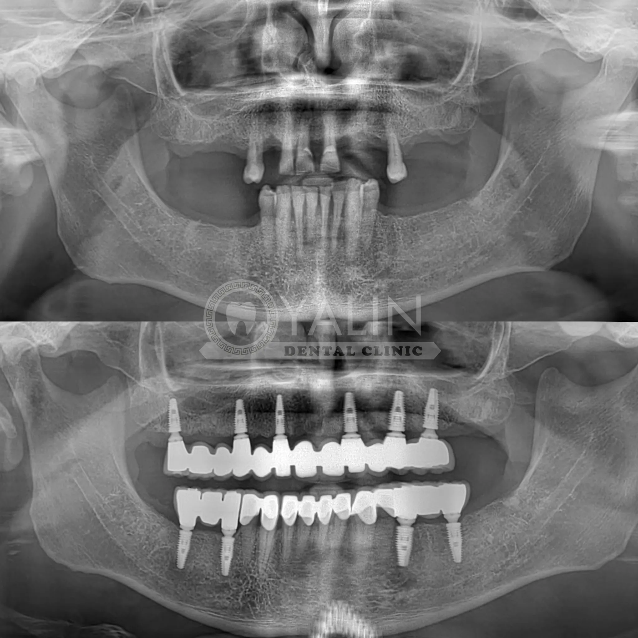 all on six implant
