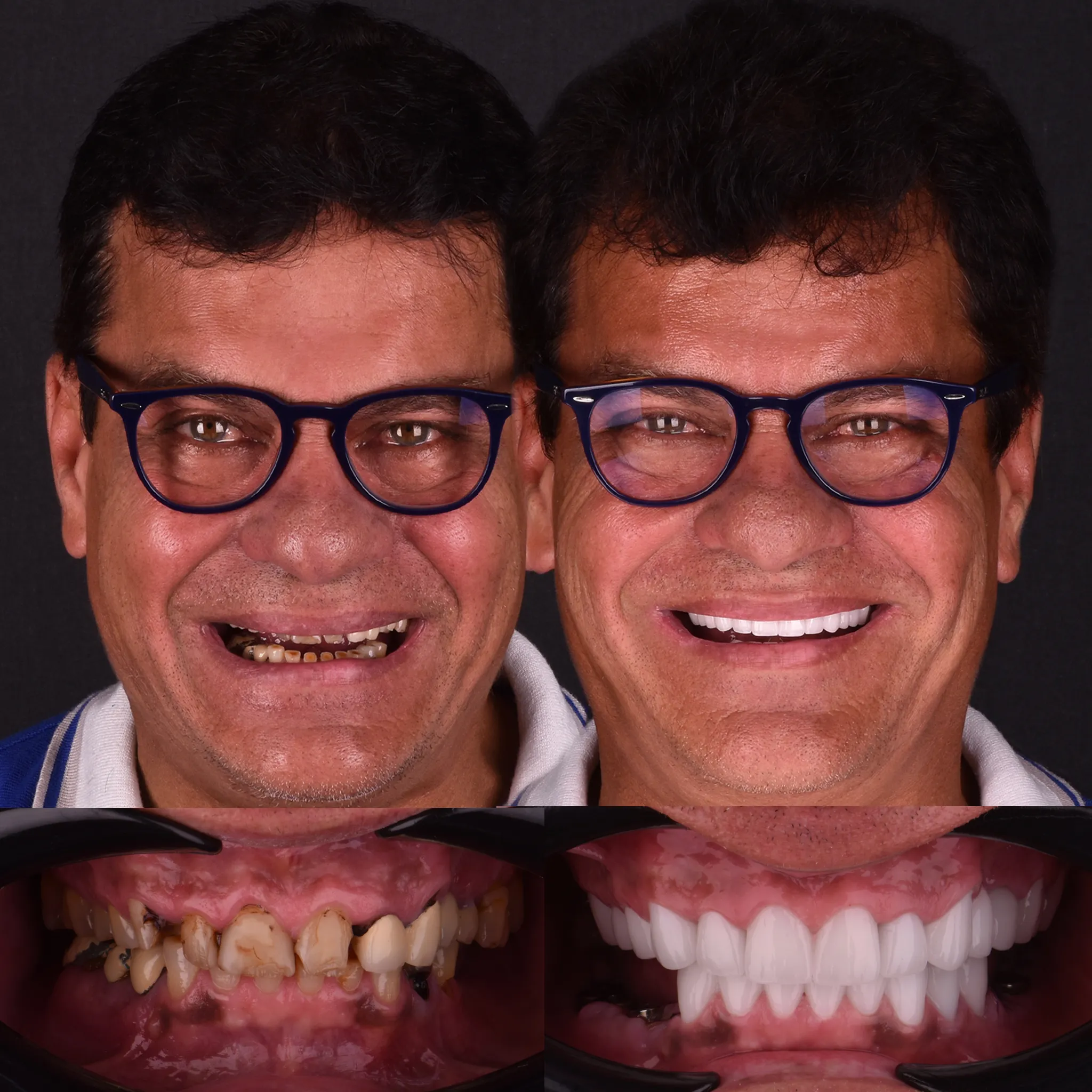 antalya dental clinic implant treatment 2