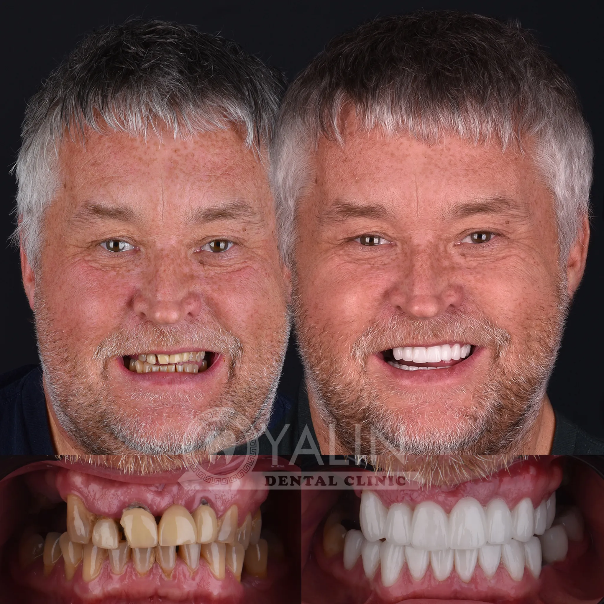 antalya dental treatments