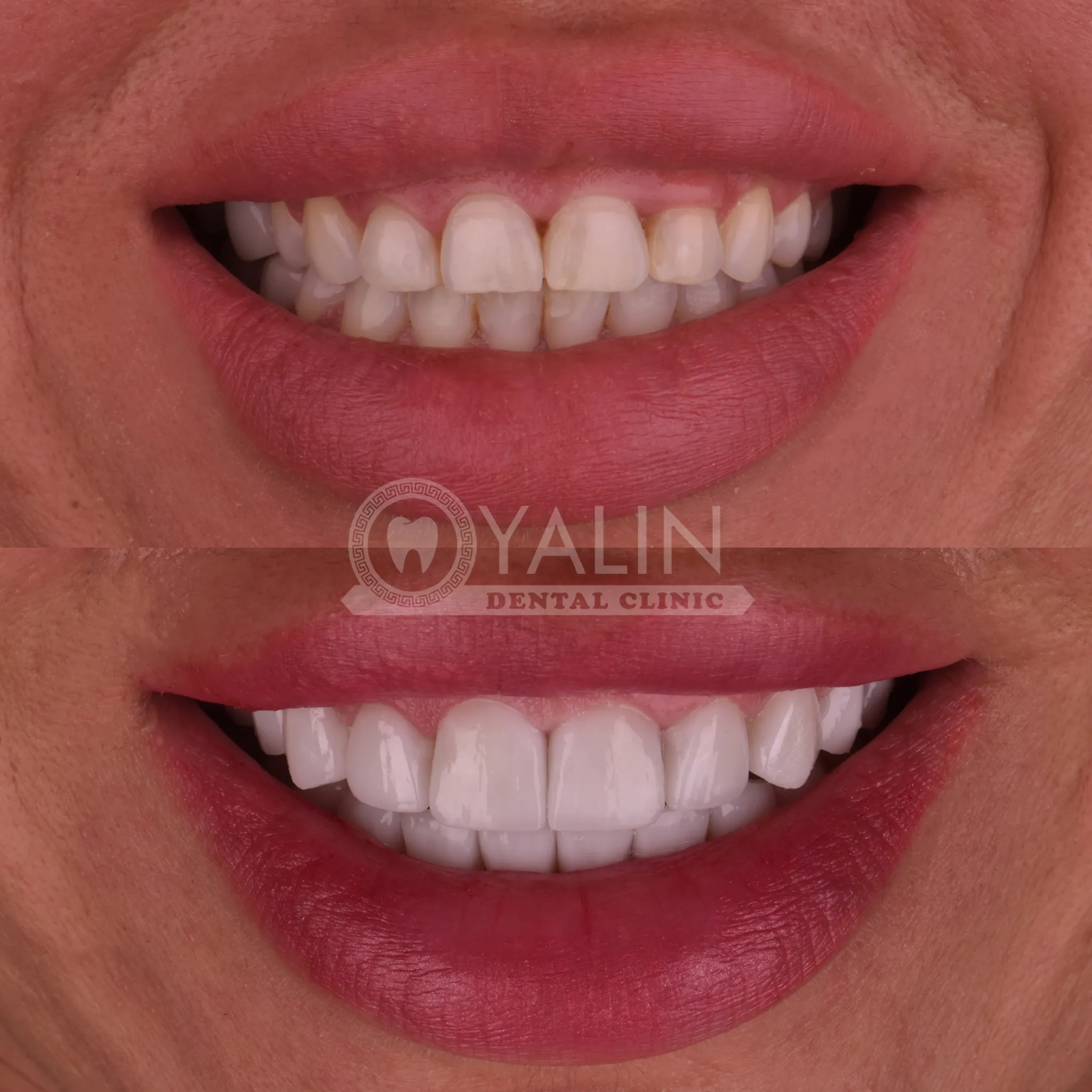 dentsmile clinic antalya