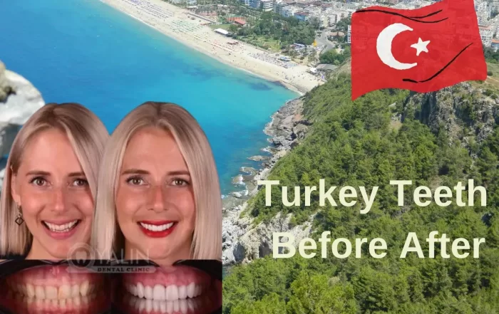 Turkey Teeth Before After